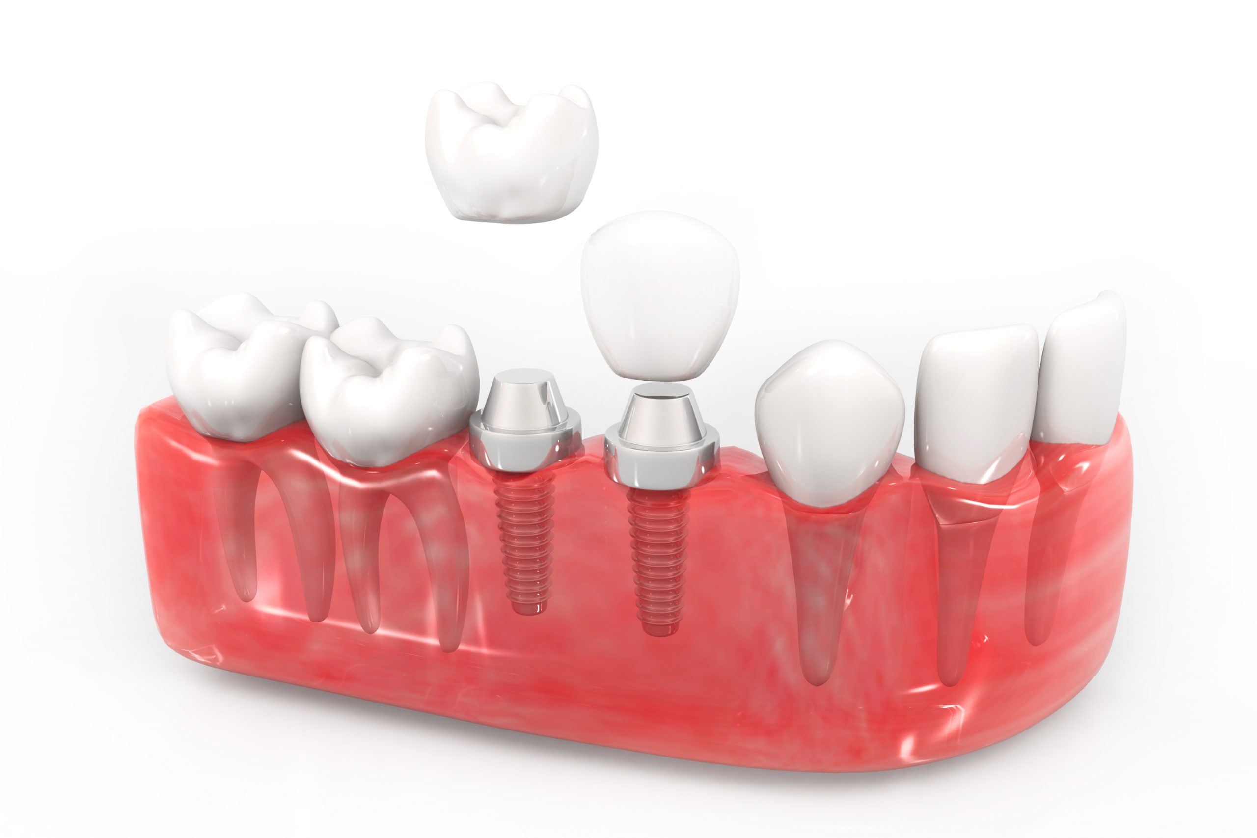 implante dental Huelva